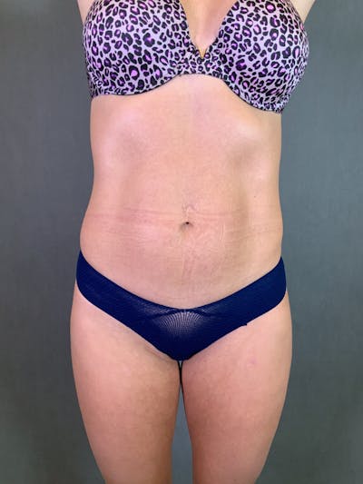 High Def Liposuction Renuvion Before & After Gallery - Patient 164234113 - Image 1