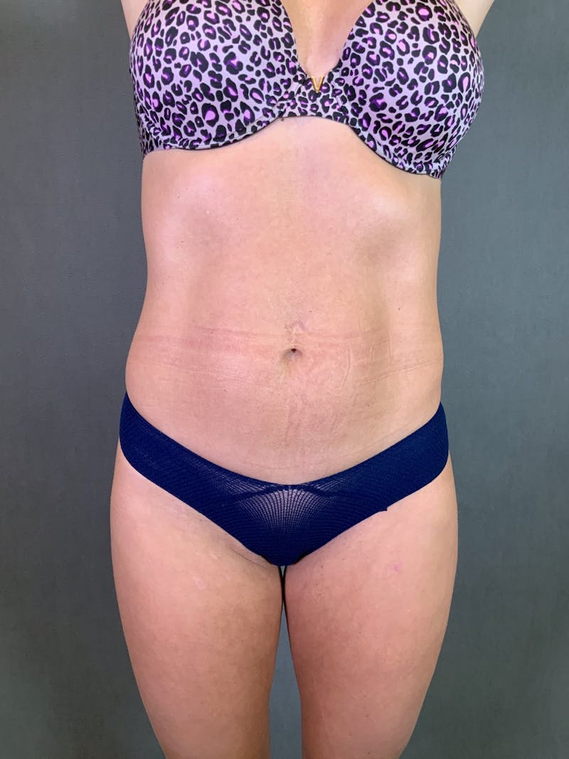 High Def Liposuction Renuvion Before & After Gallery - Patient 164234113 - Image 1