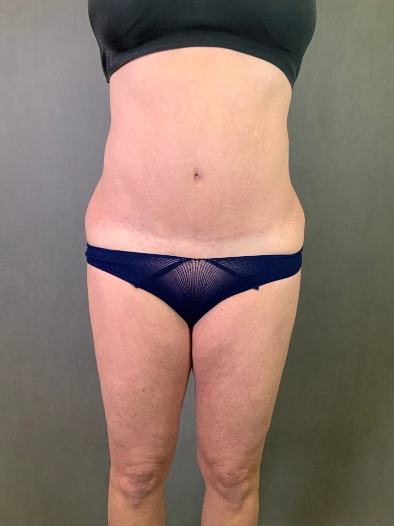 High Def Liposuction Renuvion Before & After Gallery - Patient 164234241 - Image 1