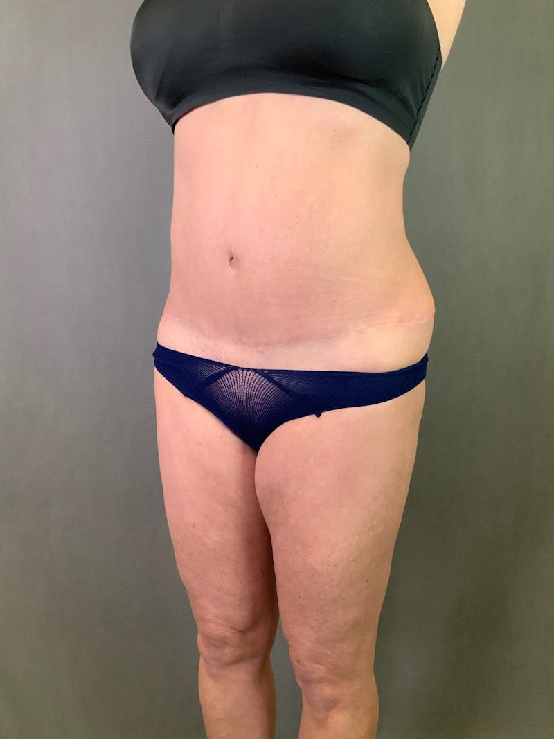 High Def Liposuction Renuvion Before & After Gallery - Patient 164234241 - Image 3