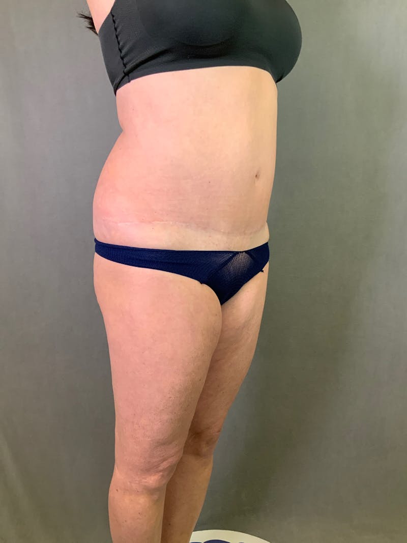 High Def Liposuction Renuvion Before & After Gallery - Patient 164234241 - Image 5