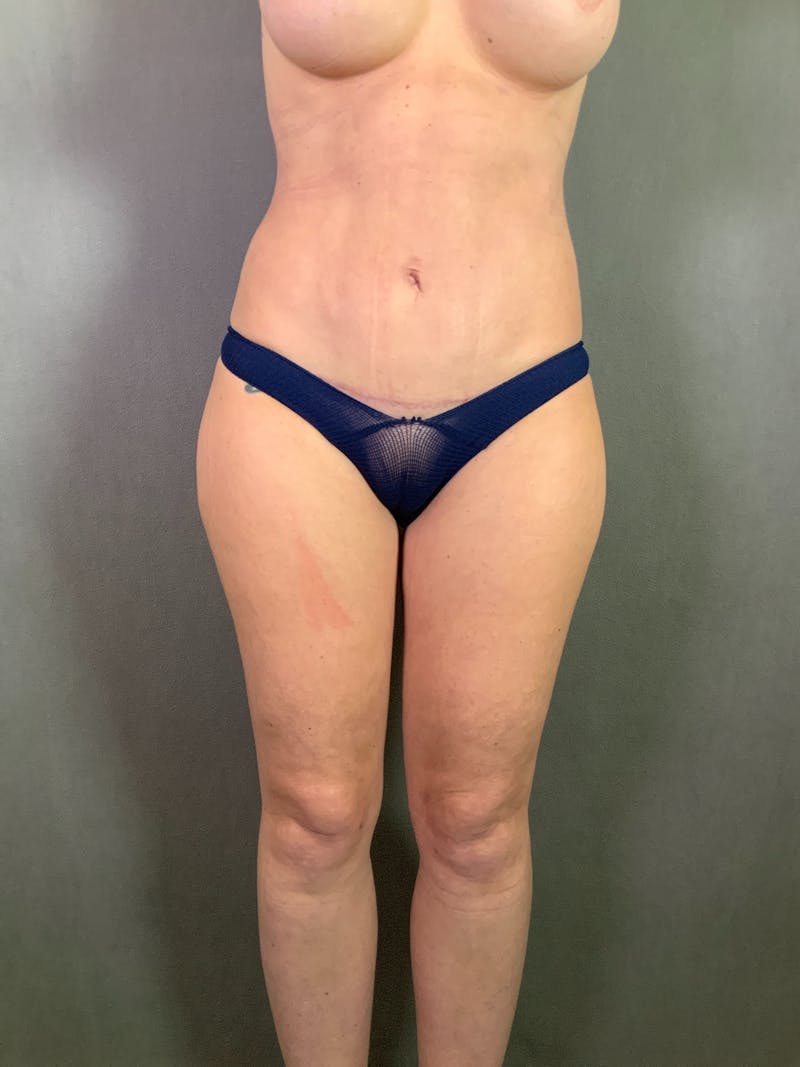 High Def Liposuction Renuvion Before & After Gallery - Patient 164234269 - Image 2