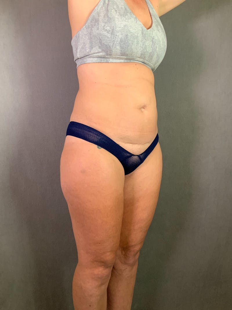 Mini-Tummy Tuck Before & After Gallery - Patient 167403220 - Image 3