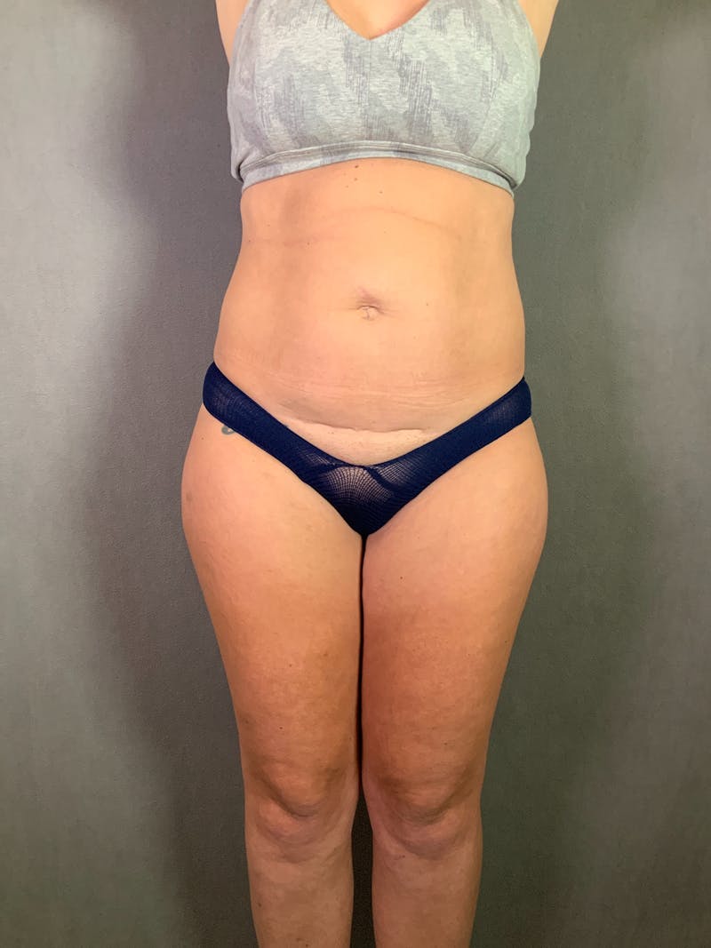 High Def Liposuction Renuvion Before & After Gallery - Patient 164234269 - Image 1