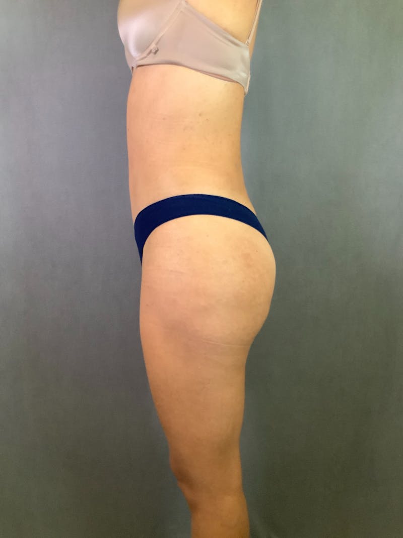 High Def Liposuction Renuvion Before & After Gallery - Patient 164242918 - Image 6