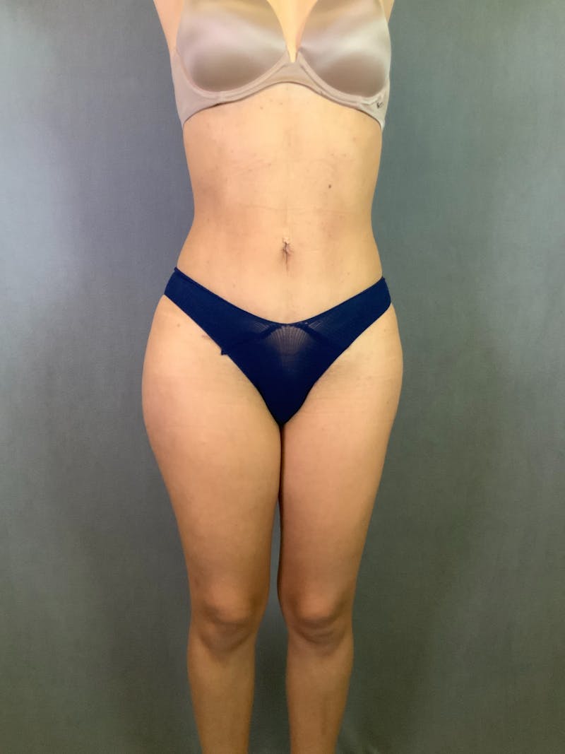 High Def Liposuction Renuvion Before & After Gallery - Patient 164242918 - Image 2