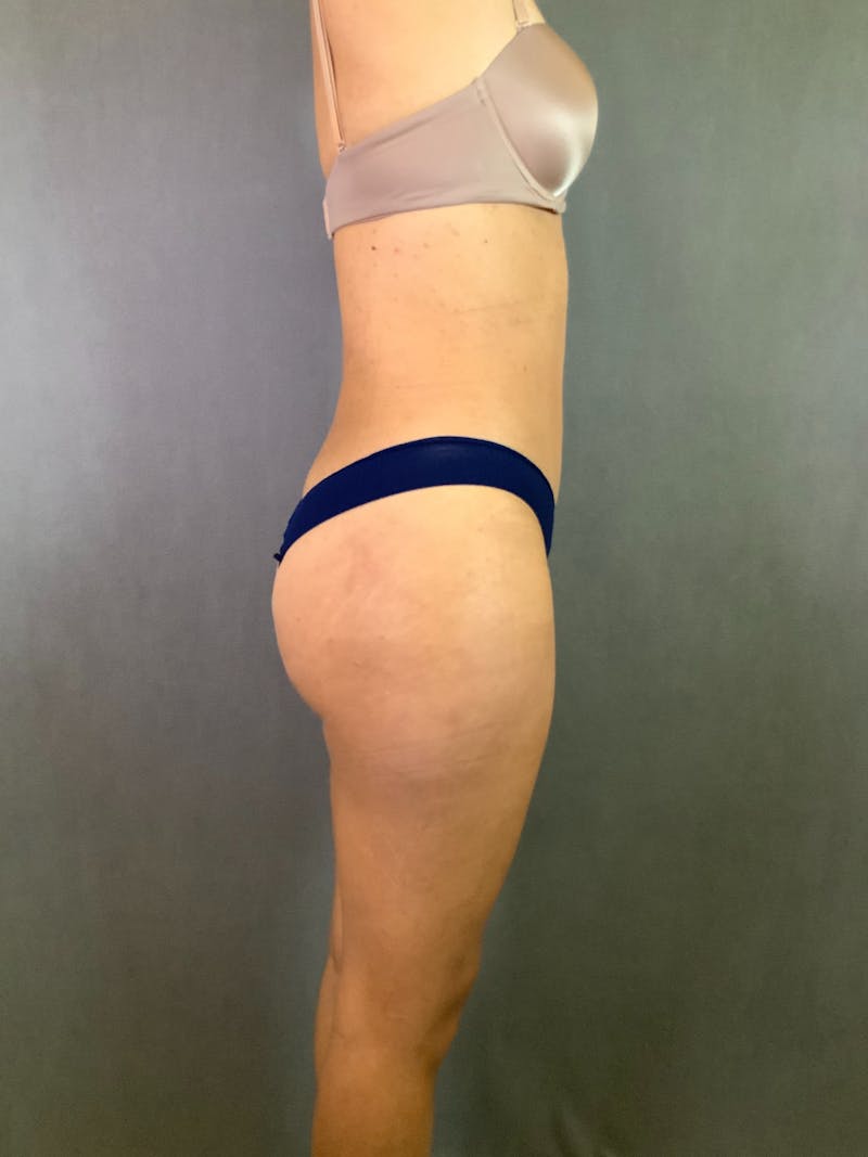 High Def Liposuction Renuvion Before & After Gallery - Patient 164242918 - Image 10