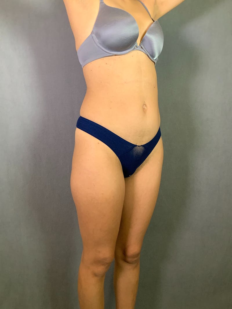 High Def Liposuction Renuvion Before & After Gallery - Patient 164242918 - Image 3