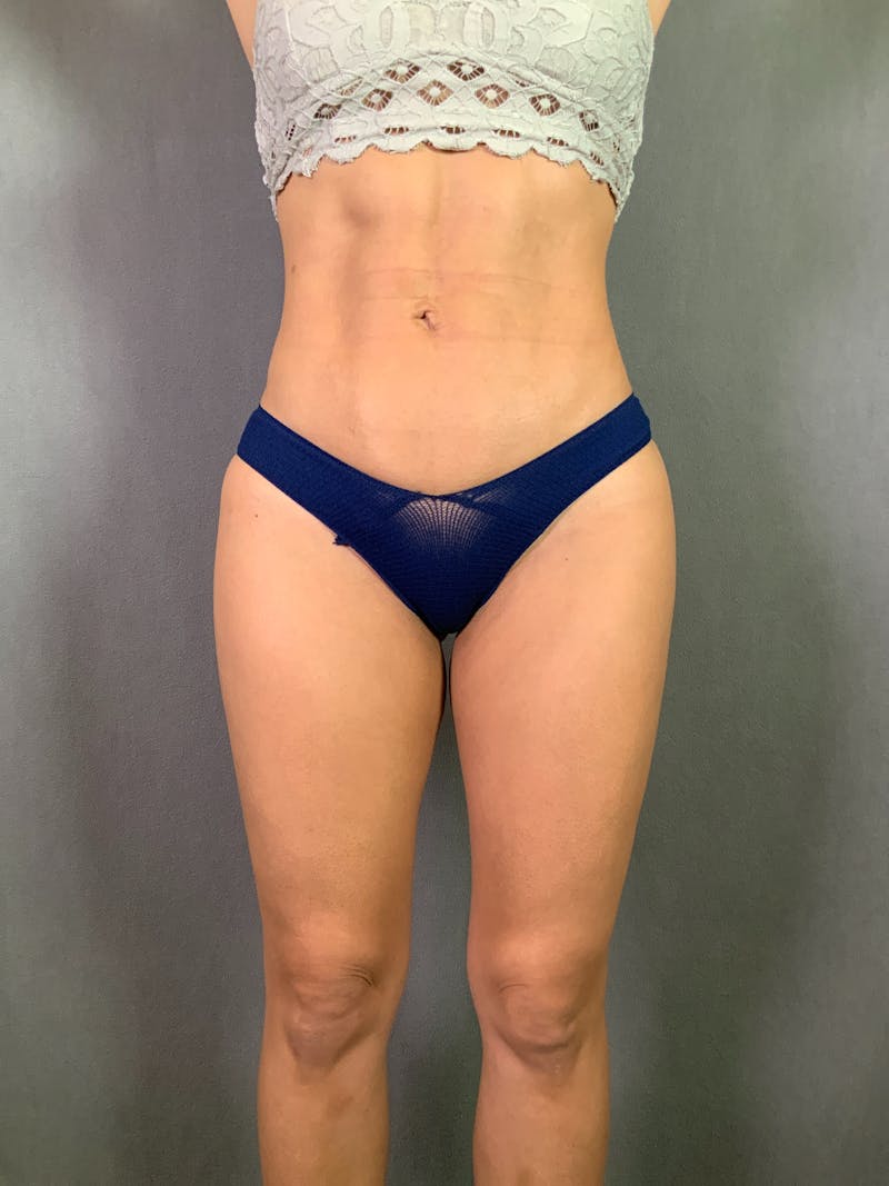 High Def Liposuction Renuvion Before & After Gallery - Patient 164246781 - Image 2