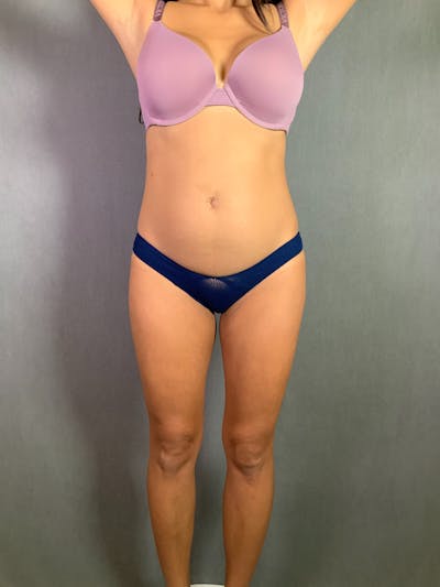 High Def Liposuction Renuvion Before & After Gallery - Patient 164246781 - Image 1