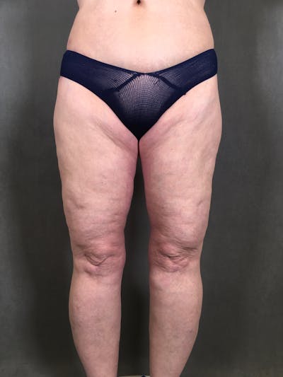 Thigh Lift Before & After Gallery - Patient 164246793 - Image 2