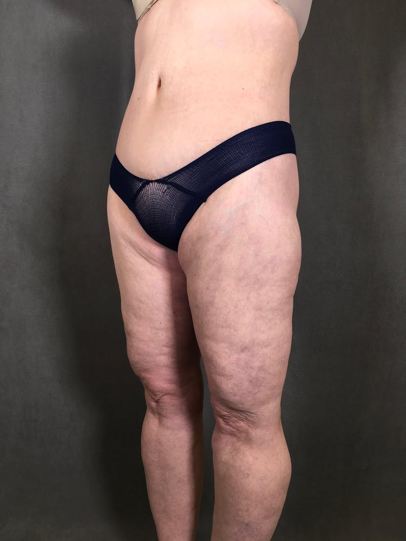 Thigh Lift Before & After Gallery - Patient 164246793 - Image 4