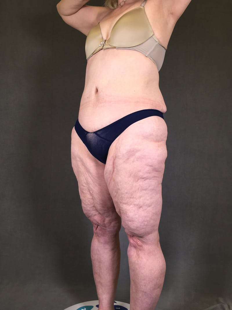 Thigh Lift Before & After Gallery - Patient 164246793 - Image 3