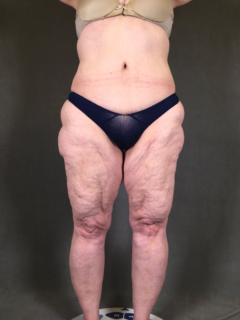 Thigh Lift Before & After Gallery - Patient 164246793 - Image 1
