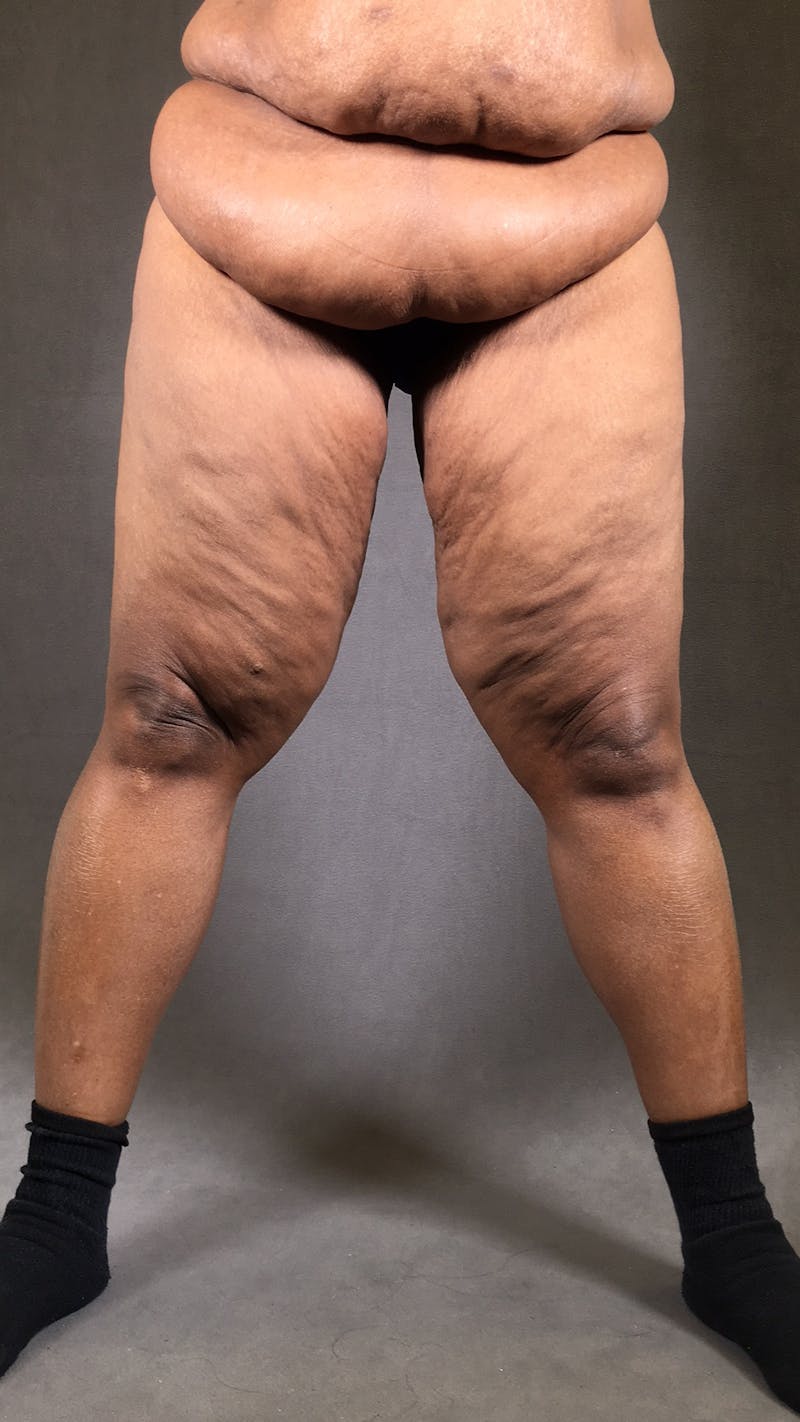 Thigh Lift Before & After Gallery - Patient 164246807 - Image 1