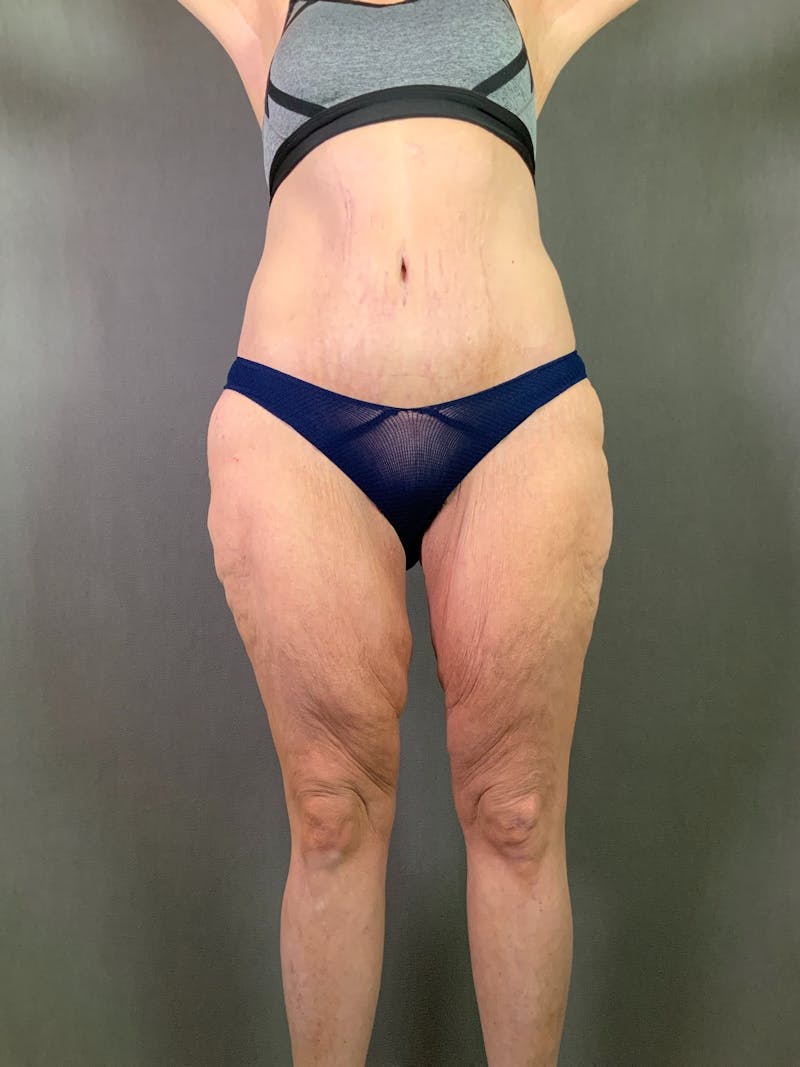 Thigh Lift Before & After Gallery - Patient 164246818 - Image 1