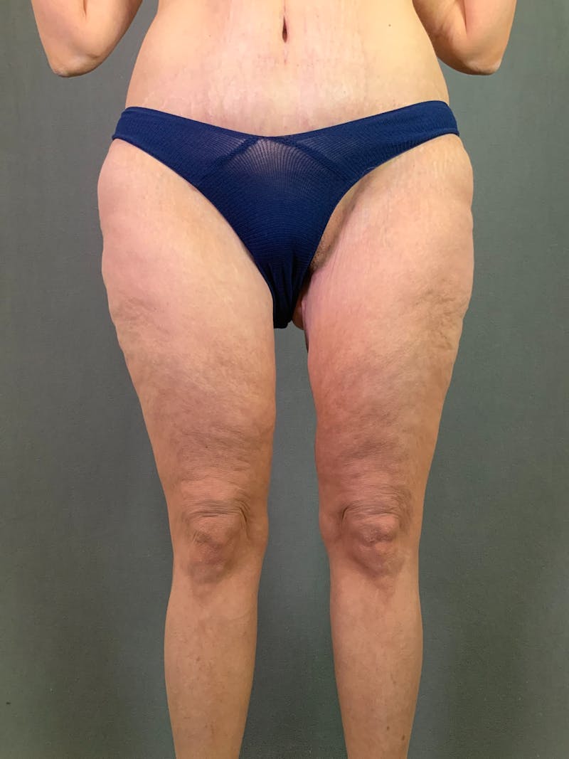 Thigh Lift Before & After Gallery - Patient 164246818 - Image 2
