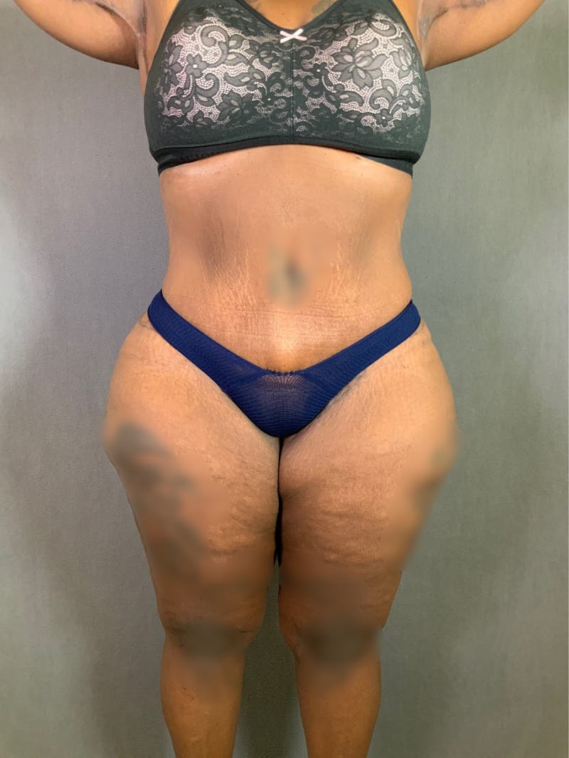 Extended Tummy Tuck  Before & After Gallery - Patient 167402485 - Image 2