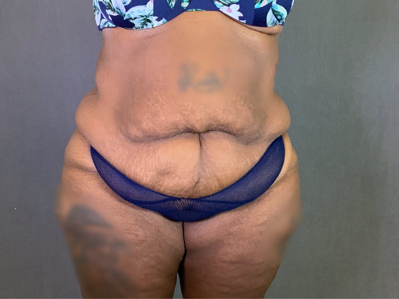 Extended Tummy Tuck  Before & After Gallery - Patient 167402485 - Image 1