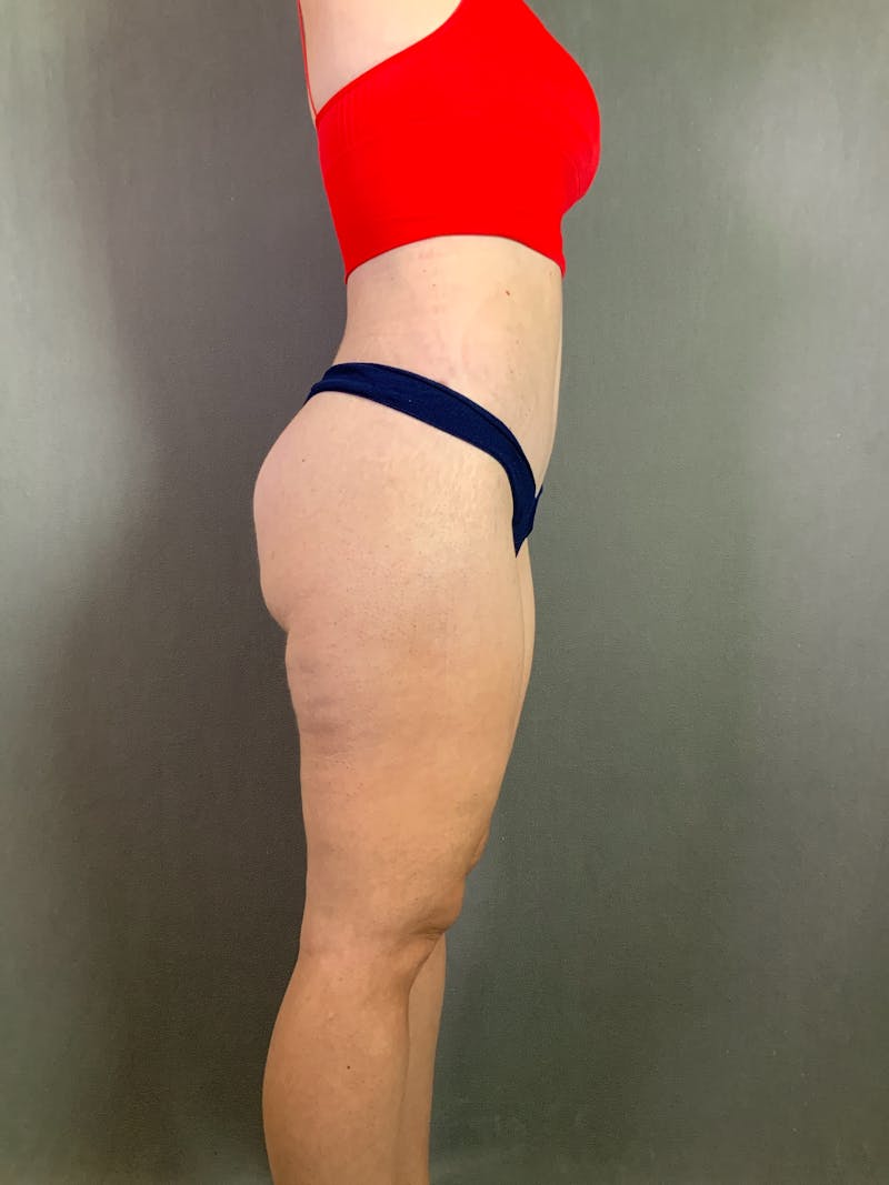 Extended Tummy Tuck  Before & After Gallery - Patient 167402490 - Image 6
