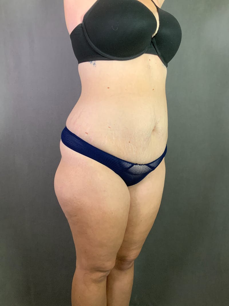 Extended Tummy Tuck  Before & After Gallery - Patient 167402490 - Image 3
