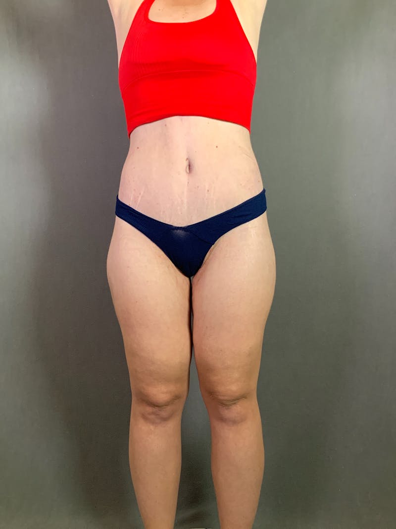 Extended Tummy Tuck  Before & After Gallery - Patient 167402490 - Image 2