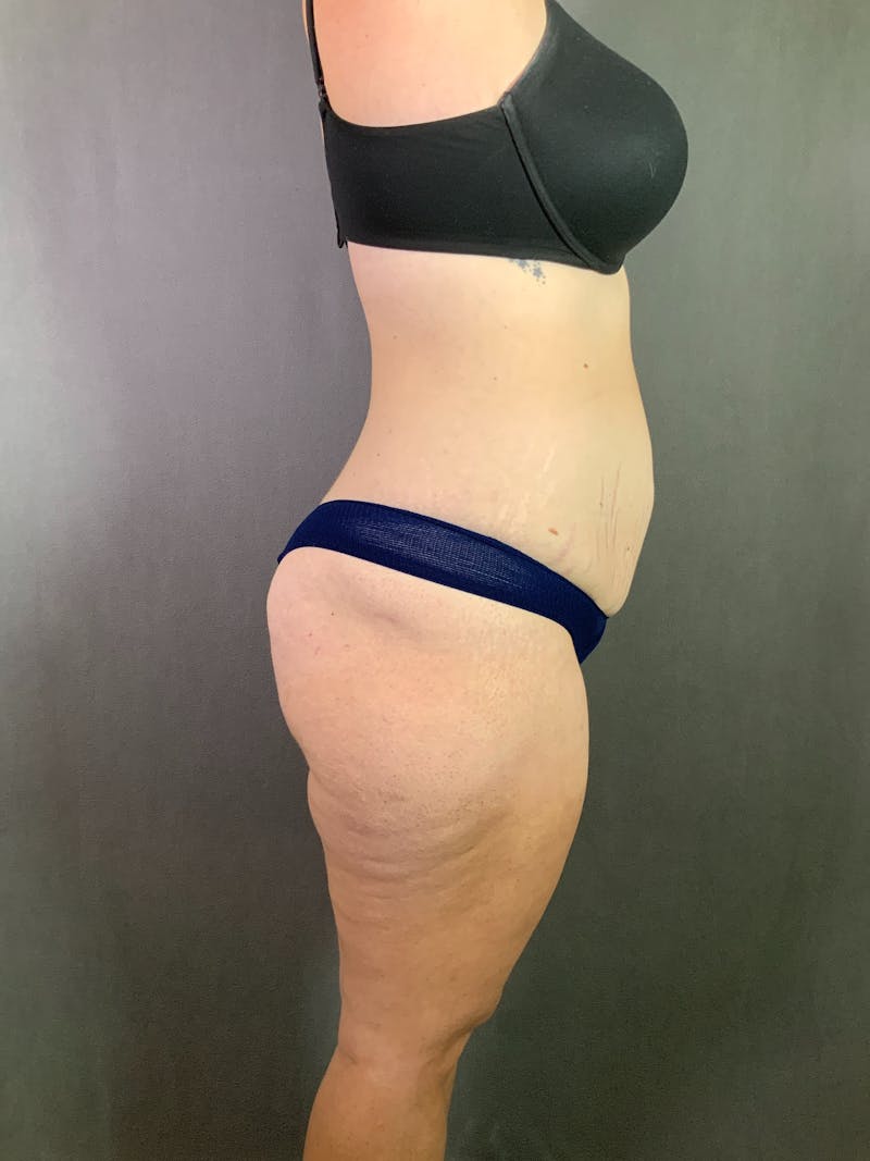 Extended Tummy Tuck  Before & After Gallery - Patient 167402490 - Image 5