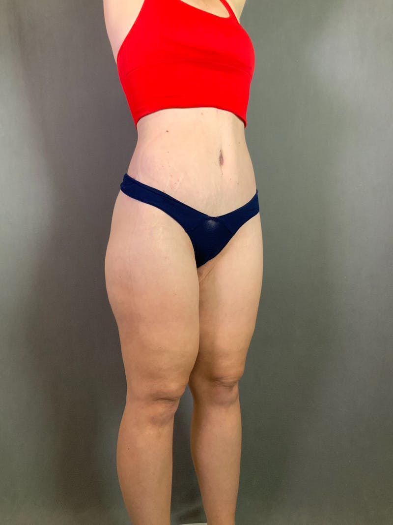 Extended Tummy Tuck  Before & After Gallery - Patient 167402490 - Image 4