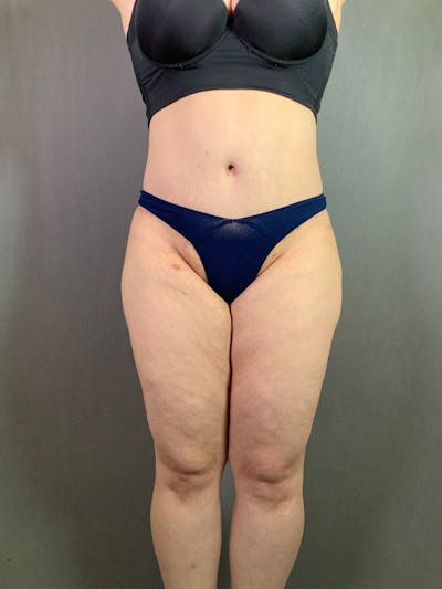 Extended Tummy Tuck  Before & After Gallery - Patient 167402492 - Image 2