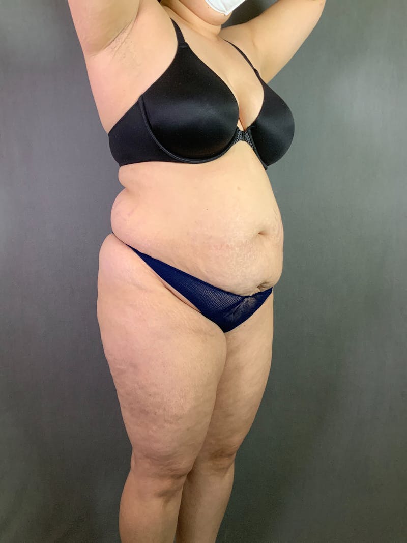 Extended Tummy Tuck  Before & After Gallery - Patient 167402492 - Image 3