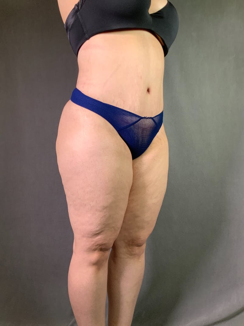 Extended Tummy Tuck  Before & After Gallery - Patient 167402492 - Image 4