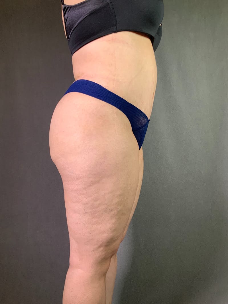 Extended Tummy Tuck  Before & After Gallery - Patient 167402492 - Image 6