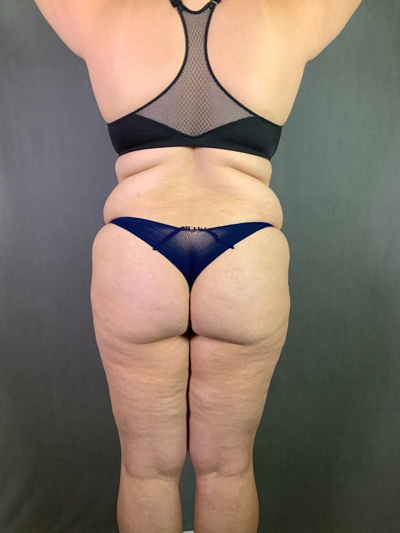 Extended Tummy Tuck  Before & After Gallery - Patient 167402492 - Image 7