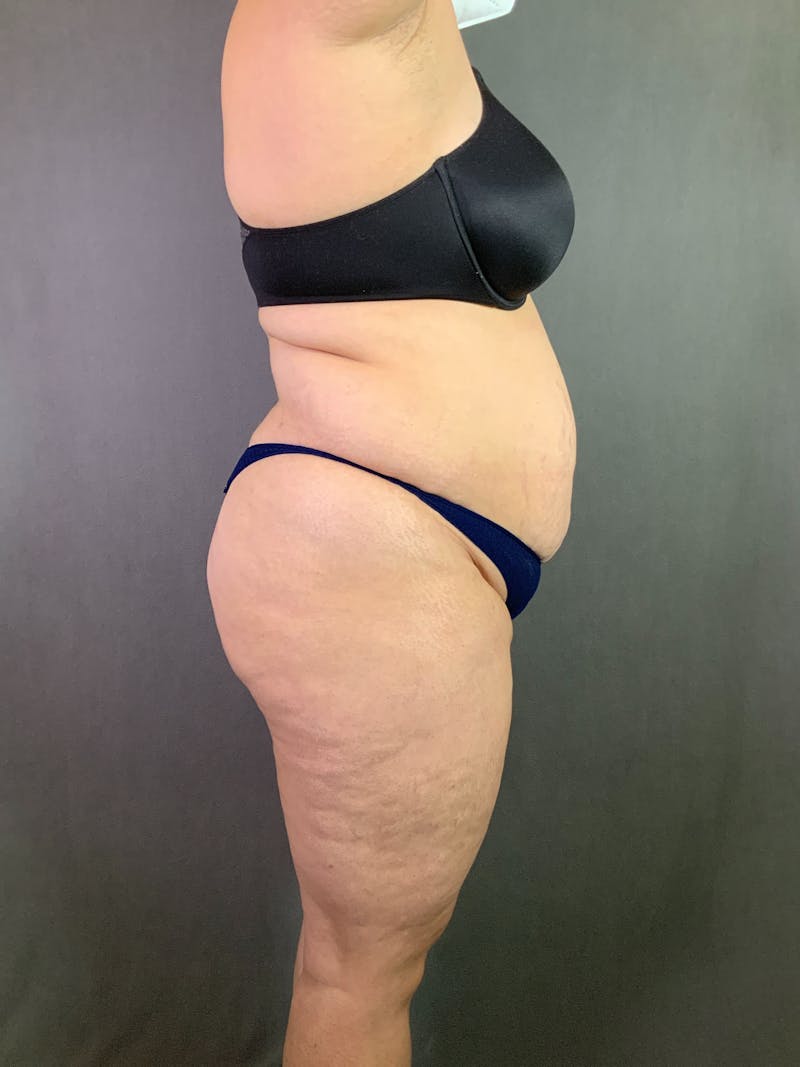 Extended Tummy Tuck  Before & After Gallery - Patient 167402492 - Image 5