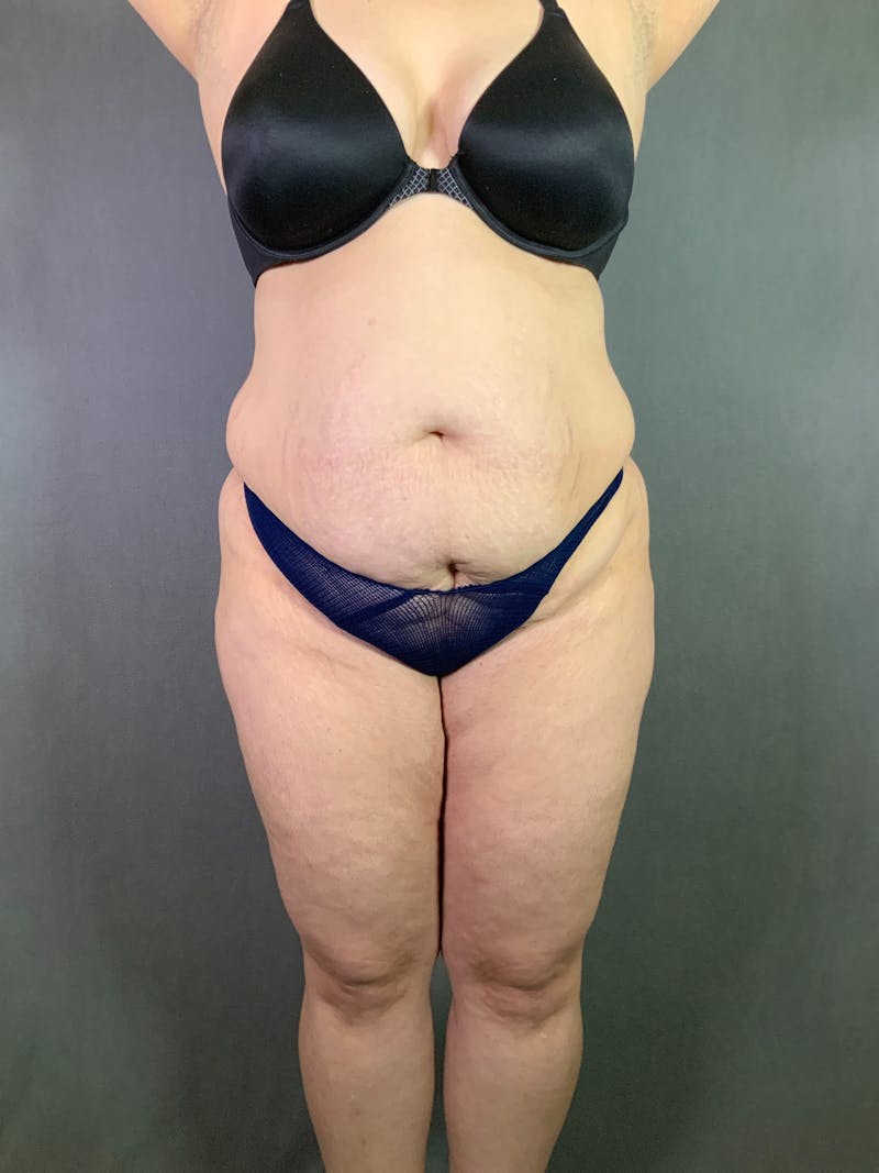 Extended Tummy Tuck  Before & After Gallery - Patient 167402492 - Image 1