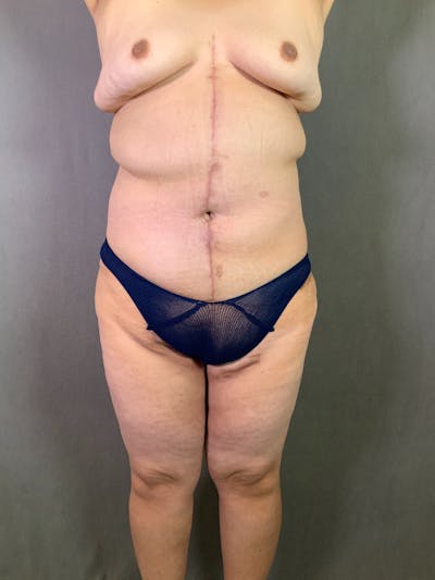 Vertical (Fleur de lis) Tummy Tuck Before & After Photos