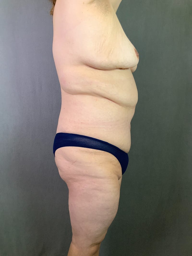 Vertical (Fleur de lis) Tummy Tuck Before & After Gallery - Patient 167402527 - Image 6