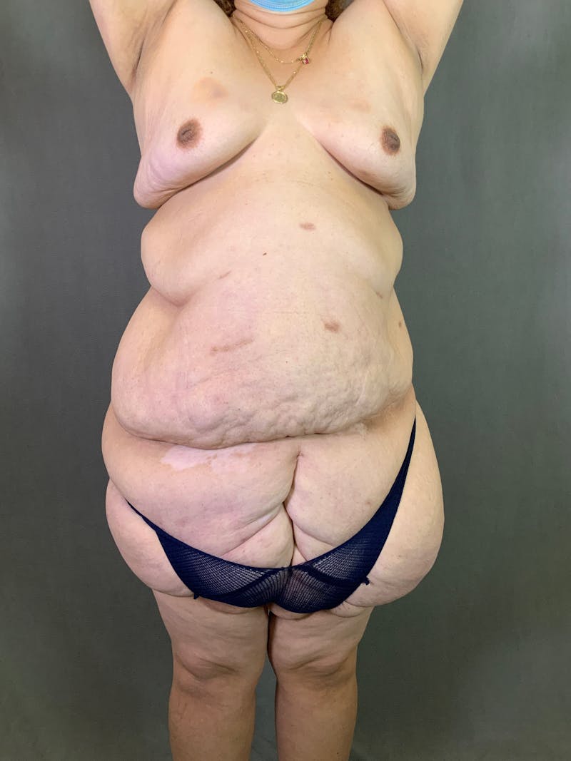 Vertical (Fleur de lis) Tummy Tuck Before & After Gallery - Patient 167402527 - Image 1