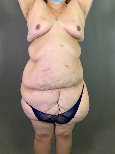 Vertical (Fleur de lis) Tummy Tuck Before & After Gallery - Patient 167402527 - Image 1