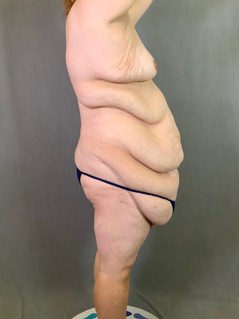 Vertical (Fleur de lis) Tummy Tuck Before & After Gallery - Patient 167402527 - Image 5