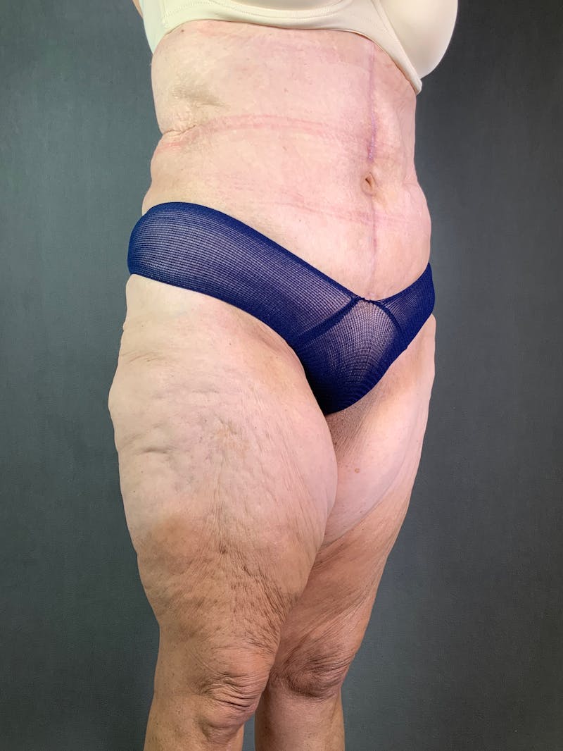 Vertical (Fleur de lis) Tummy Tuck Before & After Gallery - Patient 167402528 - Image 4