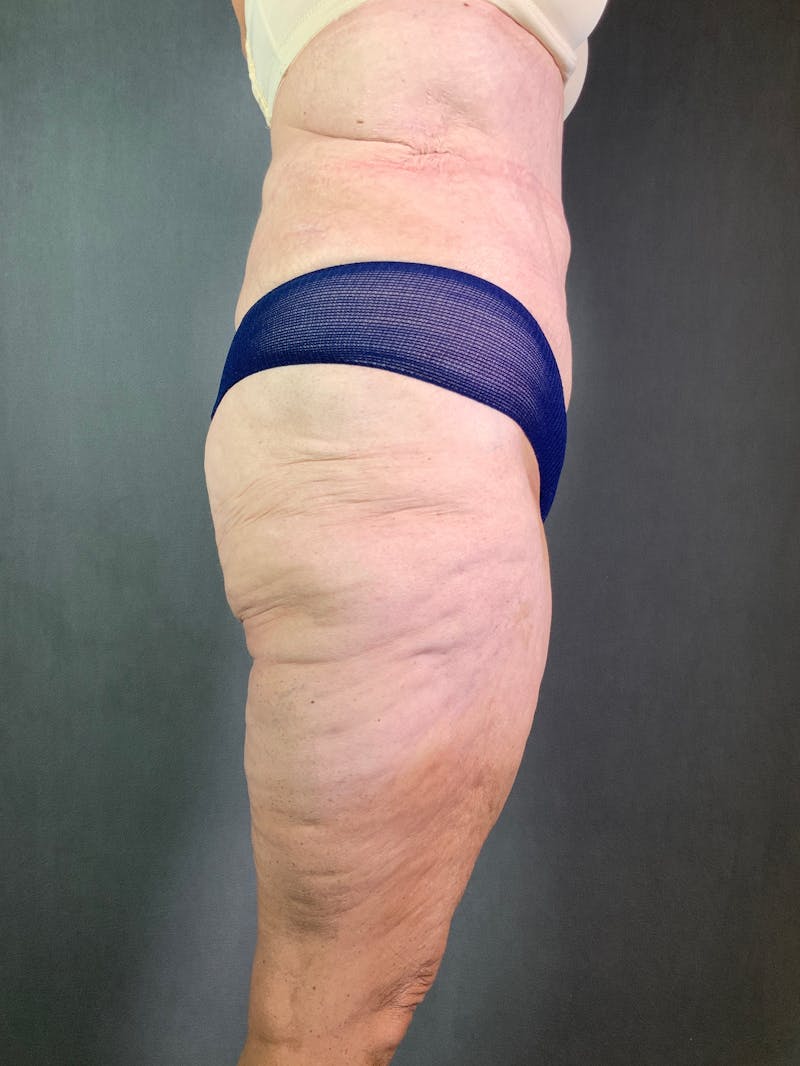 Vertical (Fleur de lis) Tummy Tuck Before & After Gallery - Patient 167402528 - Image 6