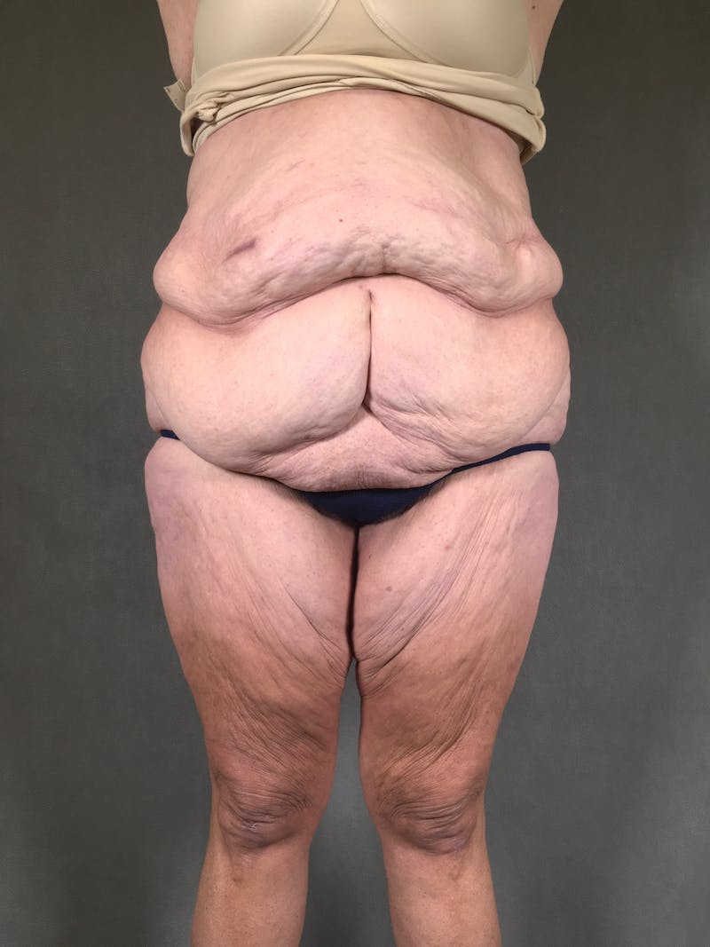 Vertical (Fleur de lis) Tummy Tuck Before & After Gallery - Patient 167402528 - Image 1