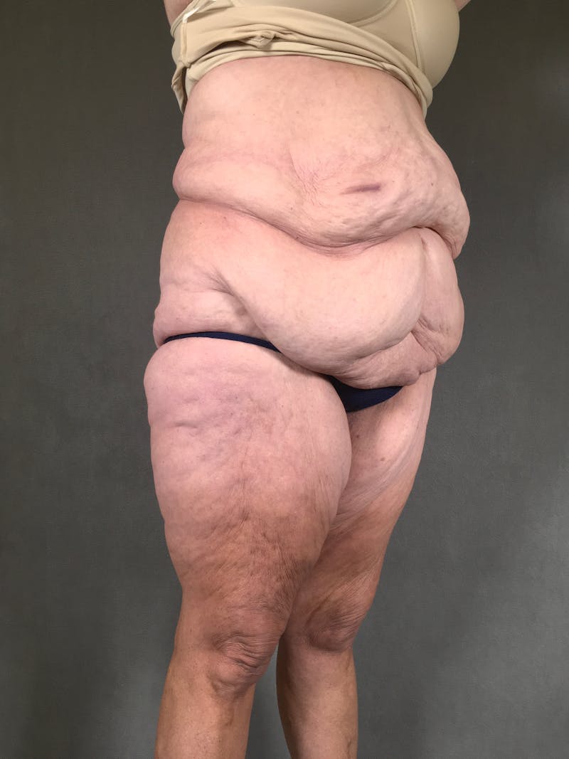 Vertical (Fleur de lis) Tummy Tuck Before & After Gallery - Patient 167402528 - Image 3