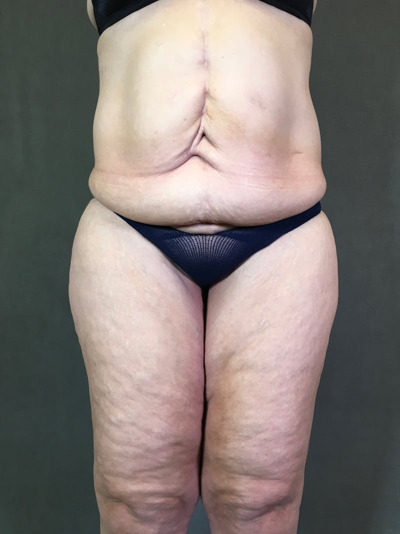 Vertical (Fleur de lis) Tummy Tuck Before & After Gallery - Patient 167402529 - Image 1