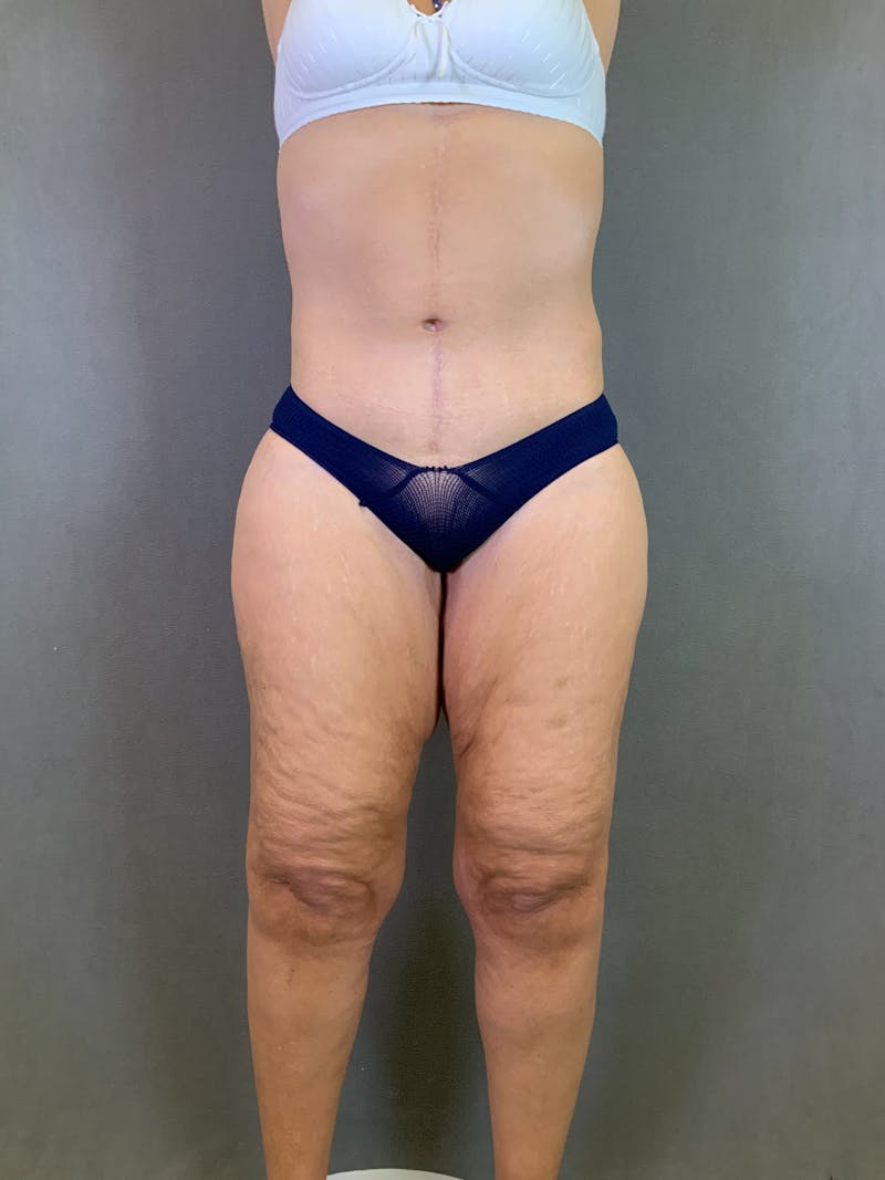 Vertical (Fleur de lis) Tummy Tuck Before & After Gallery - Patient 167402529 - Image 2