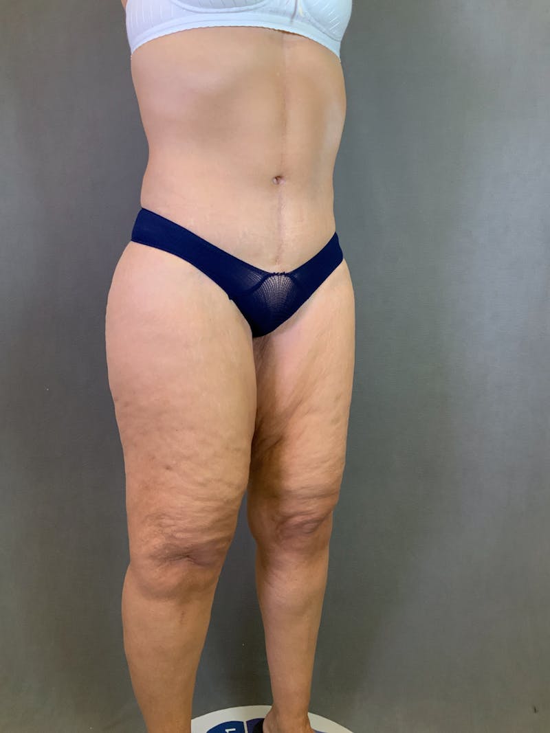 Vertical (Fleur de lis) Tummy Tuck Before & After Gallery - Patient 167402529 - Image 4