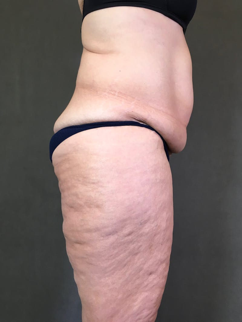 Vertical (Fleur de lis) Tummy Tuck Before & After Gallery - Patient 167402529 - Image 5