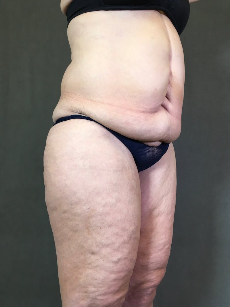 Vertical (Fleur de lis) Tummy Tuck Before & After Gallery - Patient 167402529 - Image 3