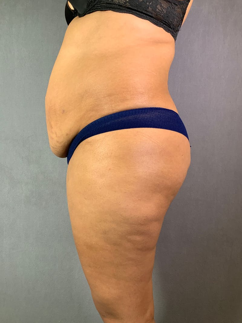 Vertical (Fleur de lis) Tummy Tuck Before & After Gallery - Patient 167402567 - Image 5